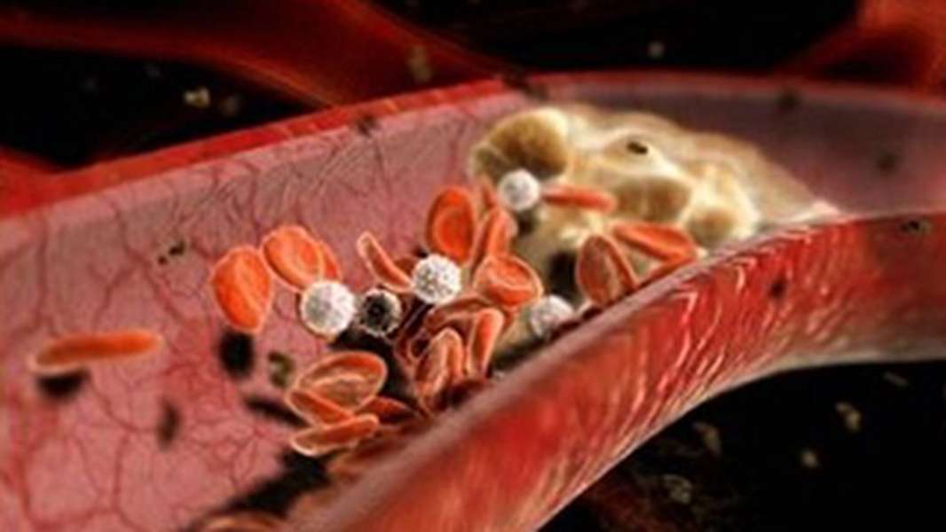 Diseminated Intravascular Coagulation - Hình ảnh minh họa